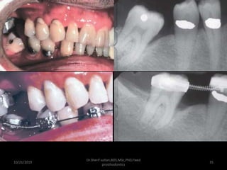 10/21/2019
Dr.Sherif sultan,BDS,MSc,PhD,Fixed
prosthodontics
35
 