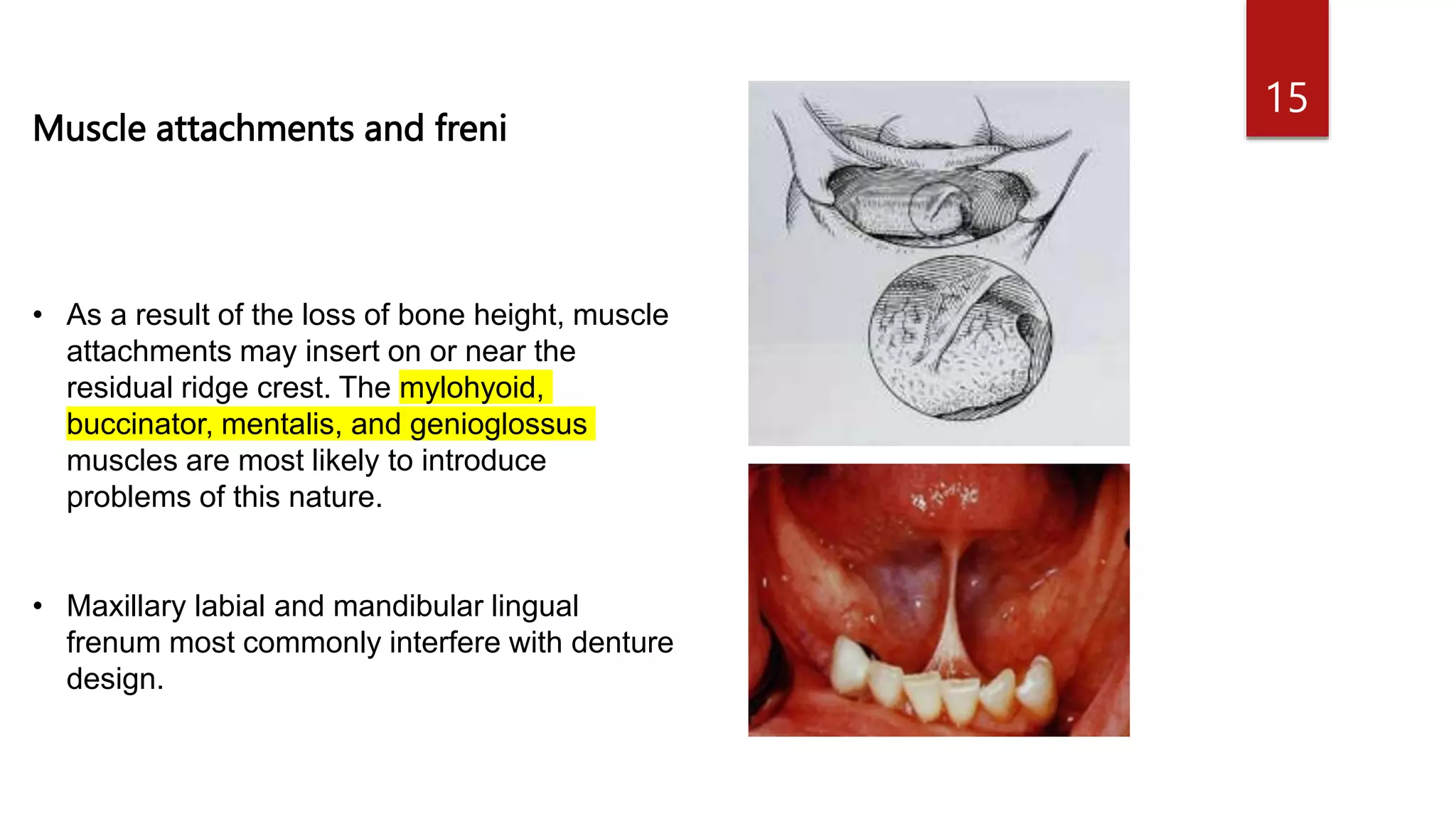 Redge Muscle MOUTH PREPARATION FOR REMOVABLE PARTIAL DENTURES.pptx
