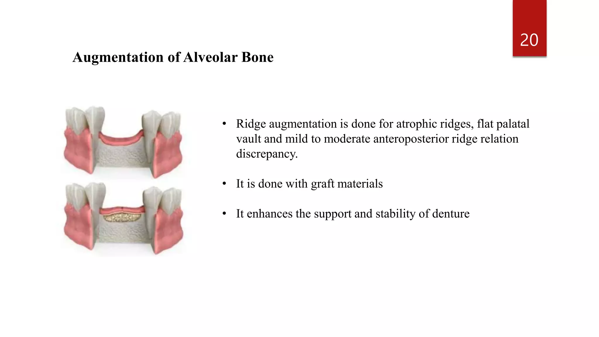 MOUTH PREPARATION FOR REMOVABLE PARTIAL DENTURES.pptx