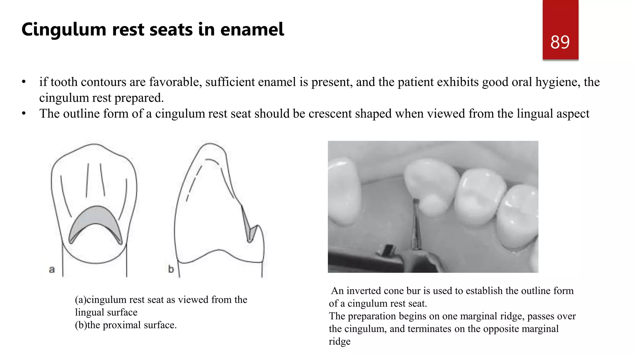 MOUTH PREPARATION FOR REMOVABLE PARTIAL DENTURES.pptx