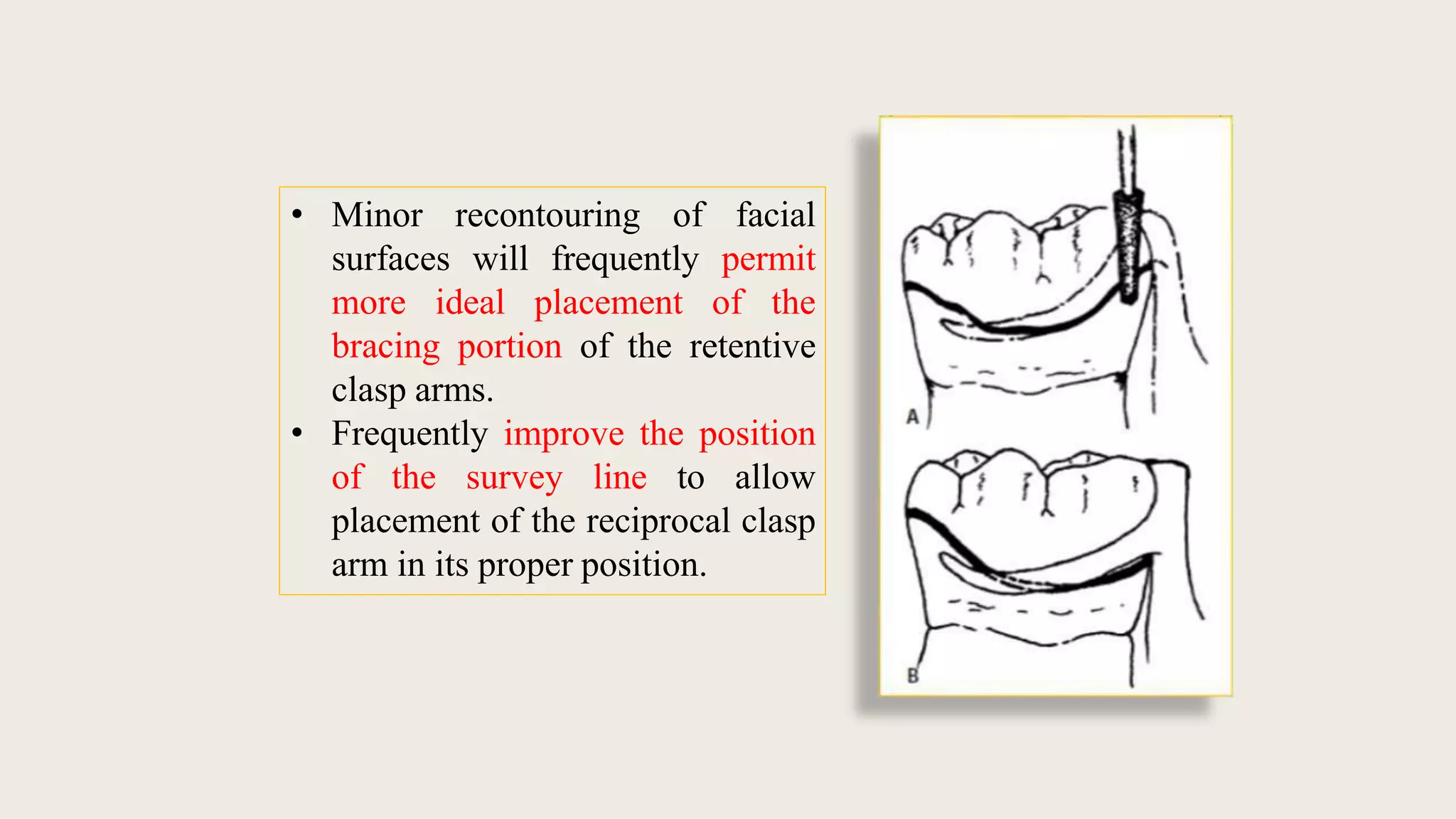 Mouth Preparation For Removable Partial Dentures.pptx