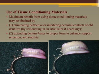 mouth preparation for rpd (2).pptx