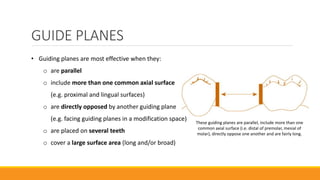 GUIDE PLANES
• Guiding planes are most effective when they:
o are parallel
o include more than one common axial surface
(e.g. proximal and lingual surfaces)
o are directly opposed by another guiding plane
(e.g. facing guiding planes in a modification space)
o are placed on several teeth
o cover a large surface area (long and/or broad)
These guiding planes are parallel, include more than one
common axial surface (i.e. distal of premolar, mesial of
molar), directly oppose one another and are fairly long.
 