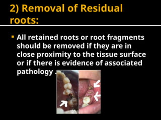 Retained Roots's Extraction Comprehensive Guide to Mouth Preparation for Removable Partial Dentures ...
