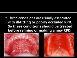 Relining In Rpd Comprehensive Guide to Mouth Preparation for Removable Partial Dentures ...