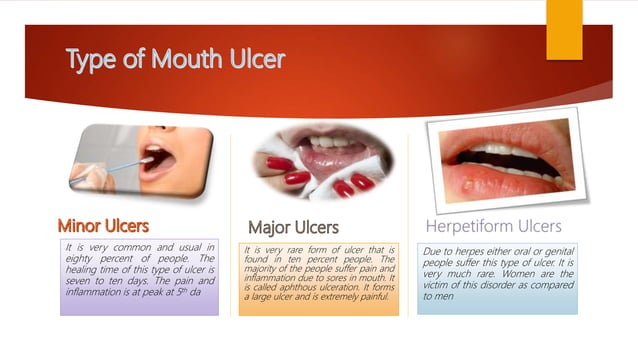 Mouth Ulcer and Cure | PPT