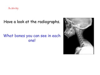 Activity Have a look at the radiographs. What bones you can see in each one! 