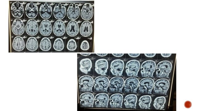 MOVEMENT DISORDER FULL chbg hypertension hyperglycemia.pptx