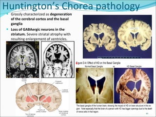 Huntington’s Chorea pathology Grossly characterized as  degeneration of the cerebral cortex and the basal ganglia Loss of GABAergic neurons in the striatum.  Severe striatal atrophy with resulting enlargement of ventricles. 