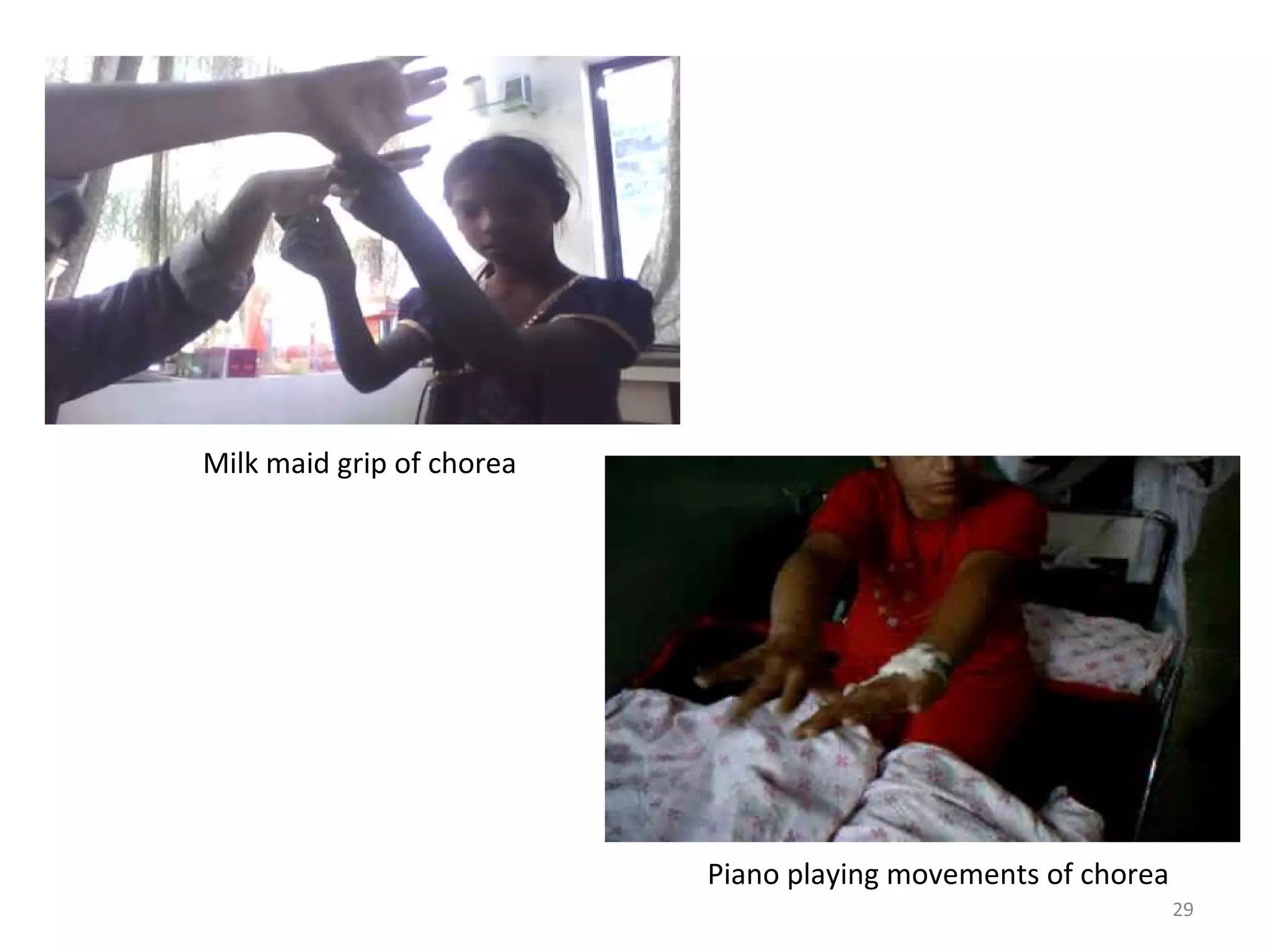 29
Milk maid grip of chorea
Piano playing movements of chorea
 