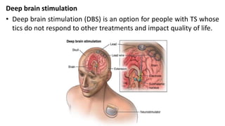 Deep brain stimulation
• Deep brain stimulation (DBS) is an option for people with TS whose
tics do not respond to other treatments and impact quality of life.
 