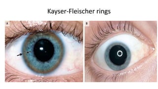 Kayser-Fleischer rings
 