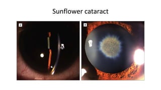 Sunflower cataract
 