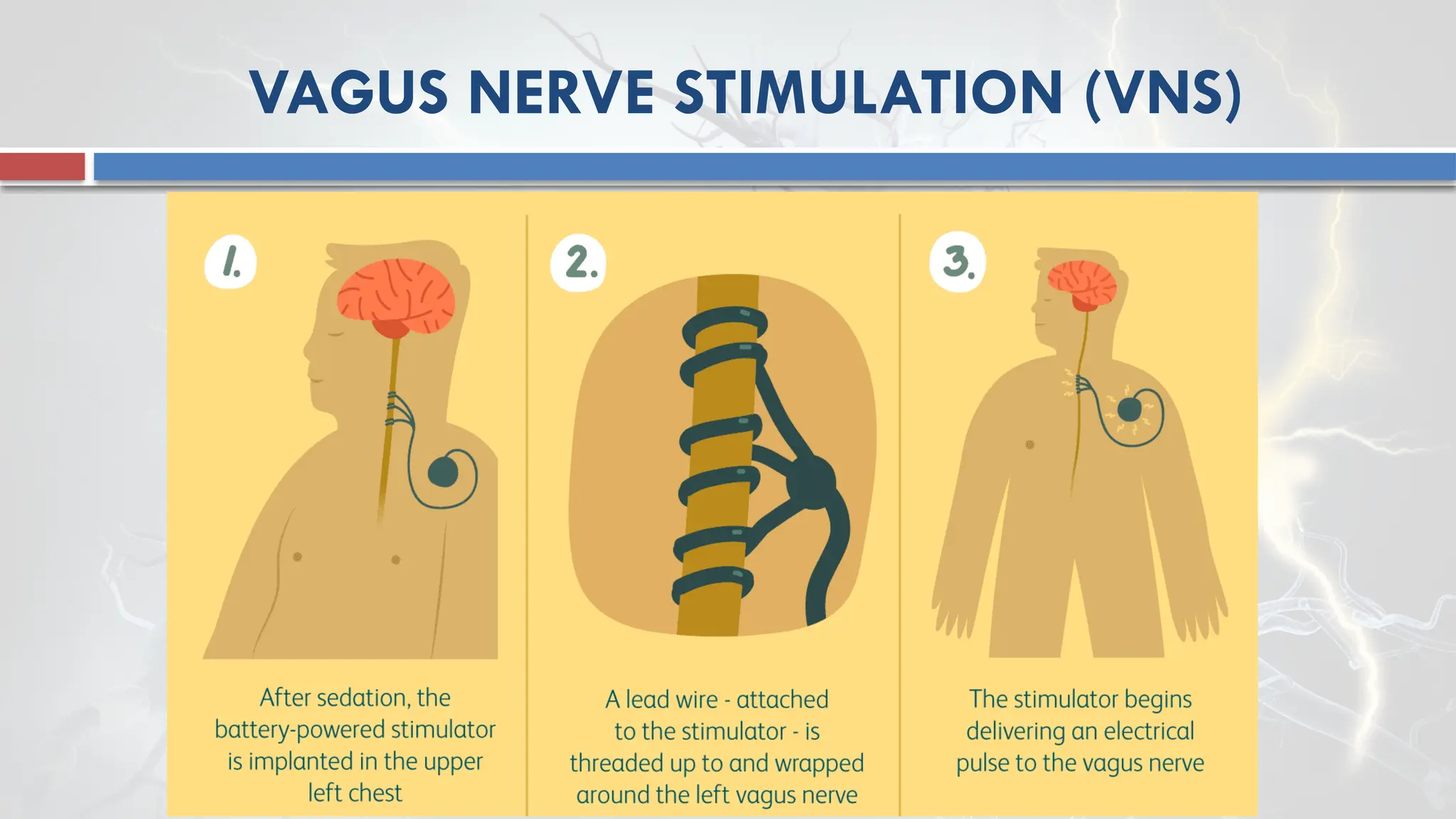 VAGUS NERVE STIMULATION (VNS)
 