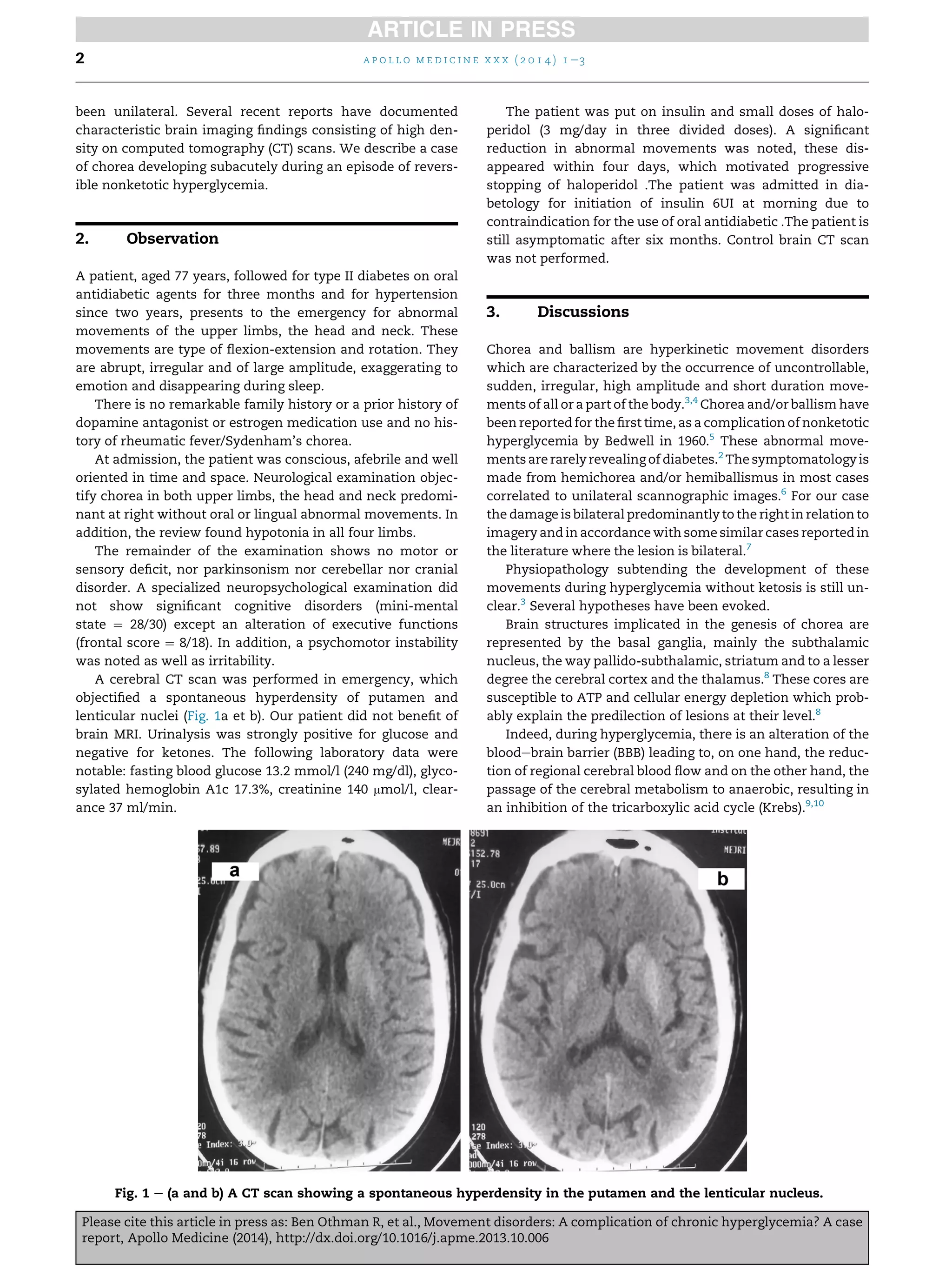 been unilateral. Several recent reports have documented
characteristic brain imaging ﬁndings consisting of high den-
sity on computed tomography (CT) scans. We describe a case
of chorea developing subacutely during an episode of revers-
ible nonketotic hyperglycemia.
2. Observation
A patient, aged 77 years, followed for type II diabetes on oral
antidiabetic agents for three months and for hypertension
since two years, presents to the emergency for abnormal
movements of the upper limbs, the head and neck. These
movements are type of ﬂexion-extension and rotation. They
are abrupt, irregular and of large amplitude, exaggerating to
emotion and disappearing during sleep.
There is no remarkable family history or a prior history of
dopamine antagonist or estrogen medication use and no his-
tory of rheumatic fever/Sydenham’s chorea.
At admission, the patient was conscious, afebrile and well
oriented in time and space. Neurological examination objec-
tify chorea in both upper limbs, the head and neck predomi-
nant at right without oral or lingual abnormal movements. In
addition, the review found hypotonia in all four limbs.
The remainder of the examination shows no motor or
sensory deﬁcit, nor parkinsonism nor cerebellar nor cranial
disorder. A specialized neuropsychological examination did
not show signiﬁcant cognitive disorders (mini-mental
state ¼ 28/30) except an alteration of executive functions
(frontal score ¼ 8/18). In addition, a psychomotor instability
was noted as well as irritability.
A cerebral CT scan was performed in emergency, which
objectiﬁed a spontaneous hyperdensity of putamen and
lenticular nuclei (Fig. 1a et b). Our patient did not beneﬁt of
brain MRI. Urinalysis was strongly positive for glucose and
negative for ketones. The following laboratory data were
notable: fasting blood glucose 13.2 mmol/l (240 mg/dl), glyco-
sylated hemoglobin A1c 17.3%, creatinine 140 mmol/l, clear-
ance 37 ml/min.
The patient was put on insulin and small doses of halo-
peridol (3 mg/day in three divided doses). A signiﬁcant
reduction in abnormal movements was noted, these dis-
appeared within four days, which motivated progressive
stopping of haloperidol .The patient was admitted in dia-
betology for initiation of insulin 6UI at morning due to
contraindication for the use of oral antidiabetic .The patient is
still asymptomatic after six months. Control brain CT scan
was not performed.
3. Discussions
Chorea and ballism are hyperkinetic movement disorders
which are characterized by the occurrence of uncontrollable,
sudden, irregular, high amplitude and short duration move-
ments of all or a part of the body.3,4
Chorea and/or ballism have
been reported for the ﬁrst time, as a complication of nonketotic
hyperglycemia by Bedwell in 1960.5
These abnormal move-
ments are rarely revealing of diabetes.2
The symptomatology is
made from hemichorea and/or hemiballismus in most cases
correlated to unilateral scannographic images.6
For our case
the damage is bilateral predominantly to the right in relation to
imagery and in accordance with some similar cases reported in
the literature where the lesion is bilateral.7
Physiopathology subtending the development of these
movements during hyperglycemia without ketosis is still un-
clear.3
Several hypotheses have been evoked.
Brain structures implicated in the genesis of chorea are
represented by the basal ganglia, mainly the subthalamic
nucleus, the way pallido-subthalamic, striatum and to a lesser
degree the cerebral cortex and the thalamus.8
These cores are
susceptible to ATP and cellular energy depletion which prob-
ably explain the predilection of lesions at their level.8
Indeed, during hyperglycemia, there is an alteration of the
bloodebrain barrier (BBB) leading to, on one hand, the reduc-
tion of regional cerebral blood ﬂow and on the other hand, the
passage of the cerebral metabolism to anaerobic, resulting in
an inhibition of the tricarboxylic acid cycle (Krebs).9,10
Fig. 1 e (a and b) A CT scan showing a spontaneous hyperdensity in the putamen and the lenticular nucleus.
a p o l l o m e d i c i n e x x x ( 2 0 1 4 ) 1 e32
Please cite this article in press as: Ben Othman R, et al., Movement disorders: A complication of chronic hyperglycemia? A case
report, Apollo Medicine (2014), http://dx.doi.org/10.1016/j.apme.2013.10.006
 