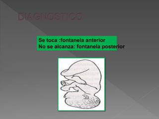 Se toca :fontanela anterior
No se alcanza: fontanela posterior
 