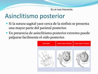 Asinclitismo posterior
 Si la sutura sagital yace cerca de la sinfisis se presenta
una mayor parte del parietal posterior.
 En presencia de asinclitismo posterior extremo puede
palparse facilmente el oido posterior.
Es el mas frecuente.
 