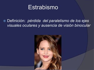 Estrabismo 
 Definición: pérdida del paralelismo de los ejes 
visuales oculares y ausencia de visión binocular 
 