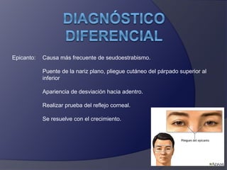 Epicanto: Causa más frecuente de seudoestrabismo. 
Puente de la nariz plano, pliegue cutáneo del párpado superior al 
inferior 
Apariencia de desviación hacia adentro. 
Realizar prueba del reflejo corneal. 
Se resuelve con el crecimiento. 
 