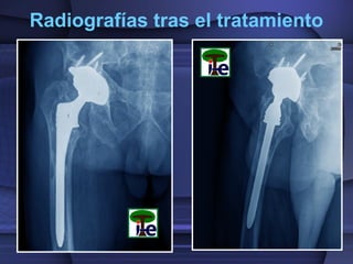 Radiografías tras el tratamiento
 