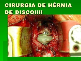 CIRURGIA DE HÉRNIA DE DISCO!!!! 