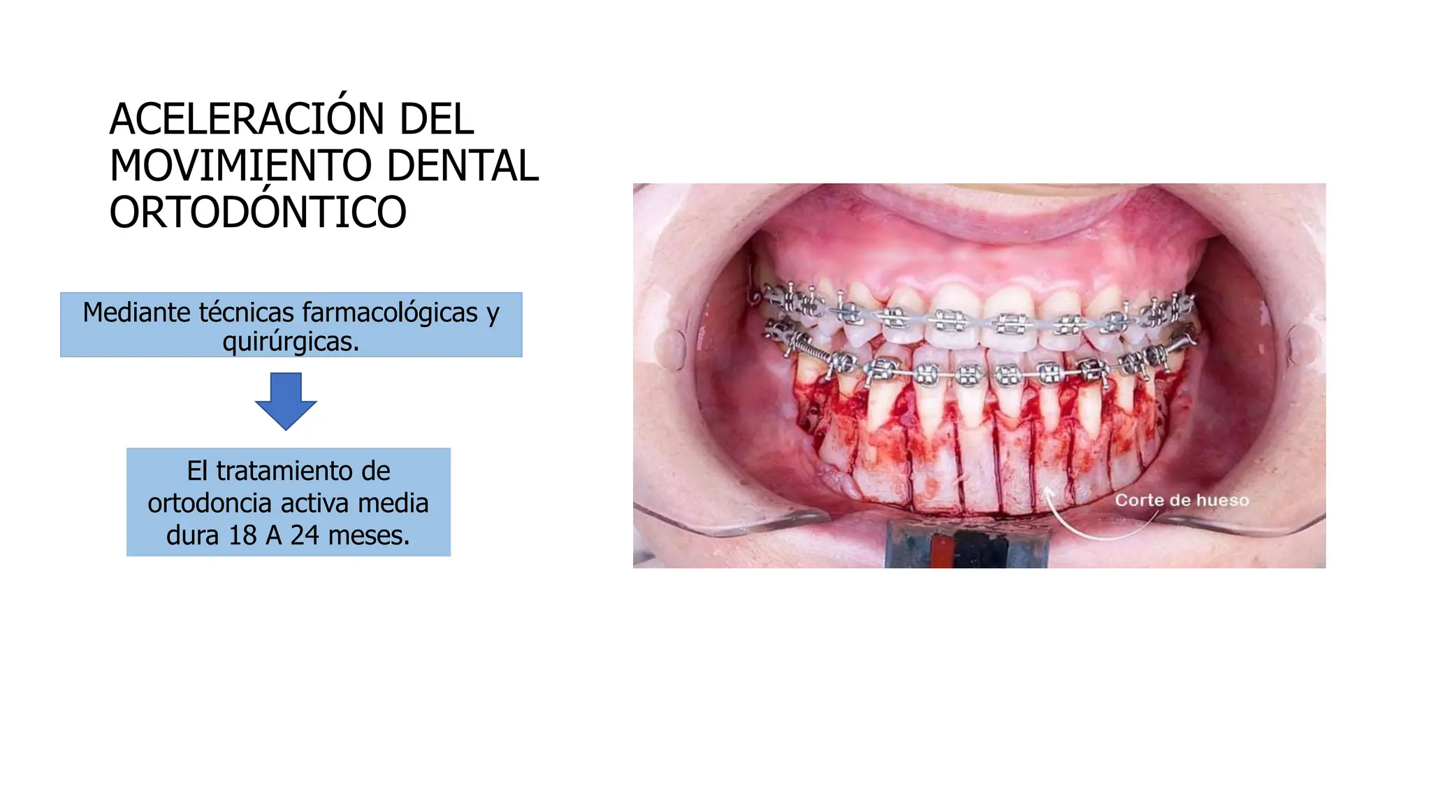 Stecca Termoformatura Sottovuoto Fogli Per Termoformatura Dentale Stecca Termoformatura Sottovuoto Fogli Per Termoformatura Dentale