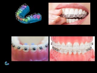 Movimiento ortodoncico