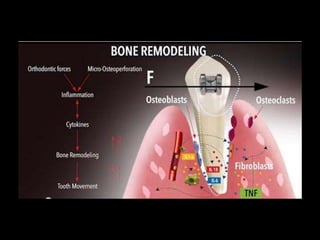 Movimiento ortodoncico