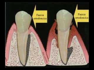 Movimiento ortodoncico