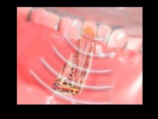 Movimiento ortodoncico