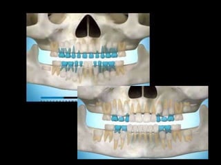 Movimiento ortodoncico