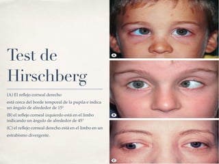 Hirschberg Examples Movimientos oculares | PDF