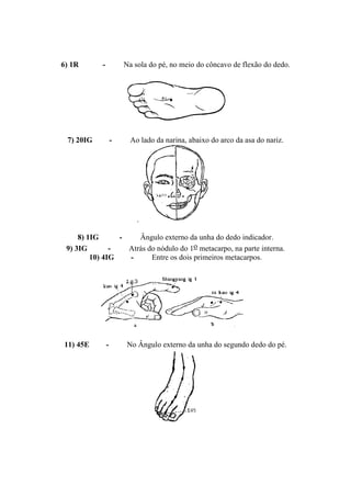6) 1R - Na sola do pé, no meio do côncavo de flexão do dedo.
7) 20IG - Ao lado da narina, abaixo do arco da asa do nariz.
.
8) 1IG - Ângulo externo da unha do dedo indicador.
9) 3IG - Atrás do nódulo do 1o metacarpo, na parte interna.
10) 4IG - Entre os dois primeiros metacarpos.
11) 45E - No Ângulo externo da unha do segundo dedo do pé.
 