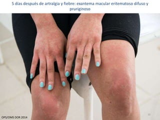 5 días después de artralgia y fiebre: exantema macular eritematoso difuso y 
10 
pruriginoso 
OPS/OMS DOR 2014 
 