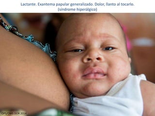 Lactante. Exantema papular generalizado. Dolor, llanto al tocarlo. 
(síndrome hiperálgico) 
11 
OPS/OMS DOR 2014 
 