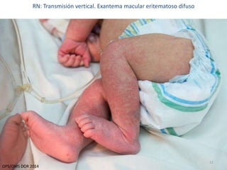 12 
RN: Transmisión vertical. Exantema macular eritematoso difuso 
OPS/OMS DOR 2014 
 