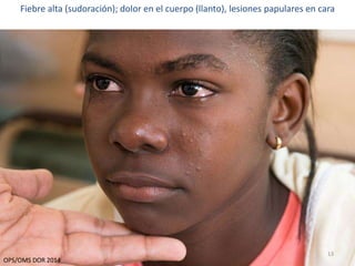 Fiebre alta (sudoración); dolor en el cuerpo (llanto), lesiones papulares en cara 
13 
OPS/OMS DOR 2014 
 