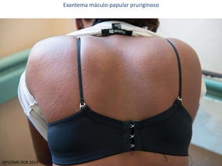 15 
Exantema máculo-papular pruriginoso 
OPS/OMS DOR 2014 
 