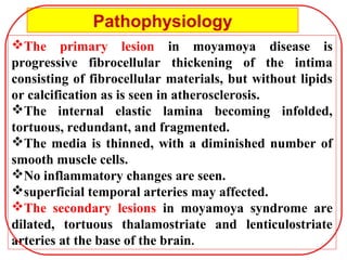 The primary lesion in moyamoya disease is
progressive fibrocellular thickening of the intima
consisting of fibrocellular materials, but without lipids
or calcification as is seen in atherosclerosis.
The internal elastic lamina becoming infolded,
tortuous, redundant, and fragmented.
The media is thinned, with a diminished number of
smooth muscle cells.
No inflammatory changes are seen.
superficial temporal arteries may affected.
The secondary lesions in moyamoya syndrome are
dilated, tortuous thalamostriate and lenticulostriate
arteries at the base of the brain.
Pathophysiology
 