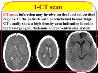 1-CT scan
CT scan: infarction may involve cortical and subcortical
regions. In the patients with parenchymal hemorrhage
CT usually show a high density area indicating blood in
the basal ganglia, thalamus and/or ventricular system
 