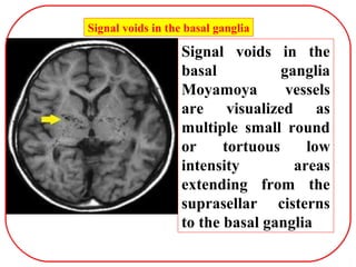 Signal voids in the basal ganglia
Signal voids in the
basal ganglia
Moyamoya vessels
are visualized as
multiple small round
or tortuous low
intensity areas
extending from the
suprasellar cisterns
to the basal ganglia
 
