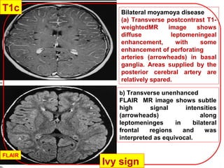 Bilateral moyamoya disease
(a) Transverse postcontrast T1-
weightedMR image shows
diffuse leptomeningeal
enhancement, with some
enhancement of perforating
arteries (arrowheads) in basal
ganglia. Areas supplied by the
posterior cerebral artery are
relatively spared.
b) Transverse unenhanced
FLAIR MR image shows subtle
high signal intensities
(arrowheads) along
leptomeninges in bilateral
frontal regions and was
interpreted as equivocal.
Ivy sign
T1c
FLAIR
 