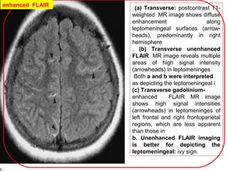 (a) Transverse: postcontrast T1-
weighted MR image shows diffuse
enhancement along
leptomeningeal surfaces (arrow-
heads), predominantly in right
hemisphere
. (b) Transverse unenhanced
FLAIR MR image reveals multiple
areas of high signal intensity
(arrowheads) in leptomeninges
Both a and b were interpreted
as depicting the leptomeningeal i
(c) Transverse gadolinium-
enhanced FLAIR MR image
shows high signal intensities
(arrowheads) in leptomeninges of
left frontal and right frontoparietal
regions, which are less apparent
than those in
b. Unenhanced FLAIR imaging
is better for depicting the
leptomeningeal: ivy sign.
enhanced FLAIR
 