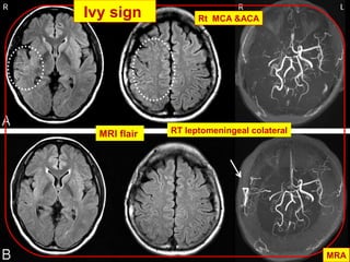 MRI flair
MRA
Rt MCA &ACA
RT leptomeningeal colateral
Ivy sign
 