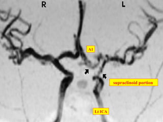 supraclinoid portion
A1
Lt ICA
 
