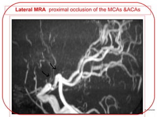 Lateral MRA proximal occlusion of the MCAs &ACAs
 