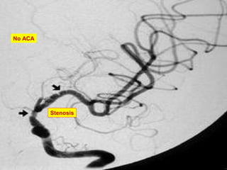 Stenosis
No ACA
 