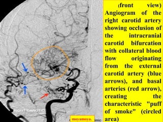 moyamoya.
(front view)
Angiogram of the
right carotid artery
showing occlusion of
the intracranial
carotid bifurcation
with collateral blood
flow originating
from the external
carotid artery (blue
arrows), and basal
arteries (red arrow),
creating the
characteristic "puff
of smoke" (circled
area)
 