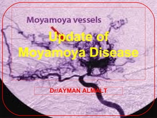 Update of
Moyamoya Disease
Dr/AYMAN ALMALT
 