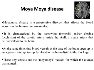 Moyamoya disease is a progressive disorder that affects the blood
vessels in the brain (cerebrovascular).
 It is characterized by the narrowing (stenosis) and/or closing
(occlusion) of the carotid artery inside the skull, a major artery that
delivers blood to the brain.
At the same time, tiny blood vessels at the base of the brain open up in
an apparent attempt to supply blood to the brain distal to the blockage.
These tiny vessels are the "moyamoya" vessels for which the disease
was named.
Moya Moya disease
 
